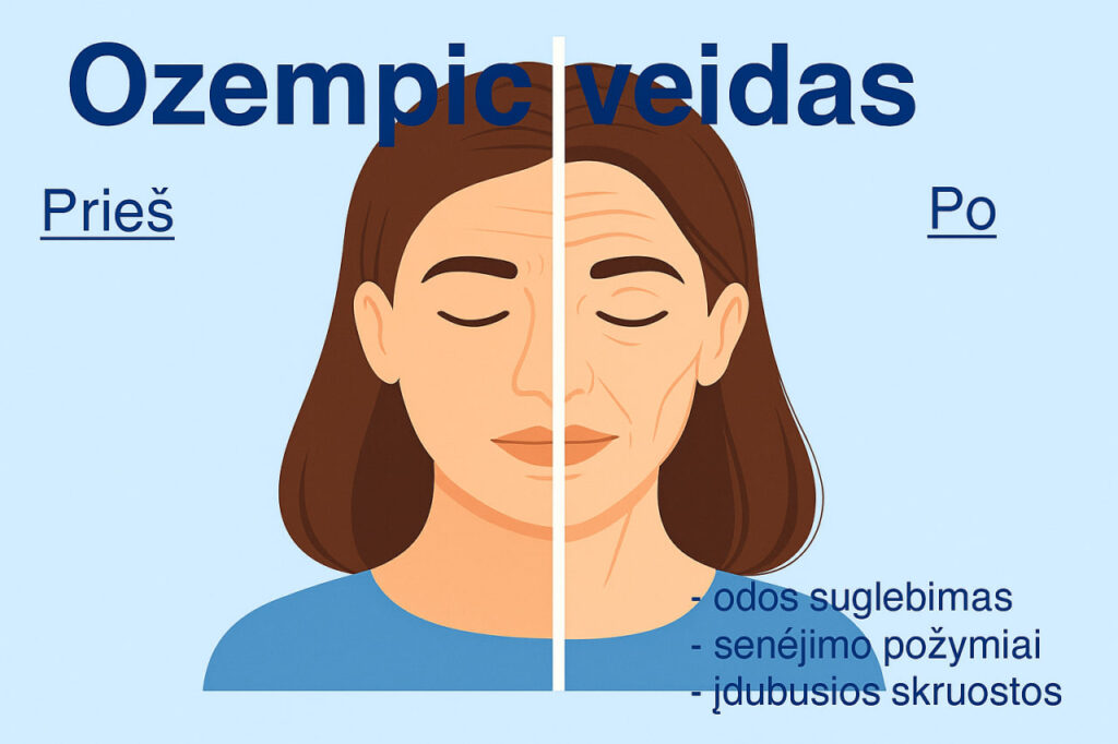 Šalutinis poveikis: Ozempic veidas